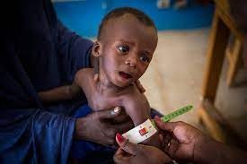 الأمم المتحدة تطلق نداء لإنقاذ 30 مليون طفل يعانون «سوء تغذية» حاد