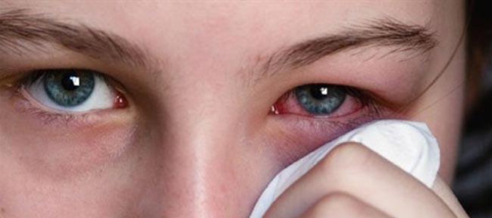 ما هي أسباب التهاب العيون في الصيف والربيع؟