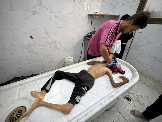 في غضون 24 ساعة.. وفاة 10 أشخاص بسبب المجاعة وسوء التغذية في قطاع غزة