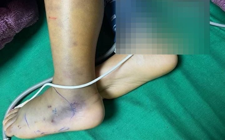 مأساة في الصوانة... ابن الـ9 سنوات يصارع الموت بعد لدغة "أفعى فلسطين"!