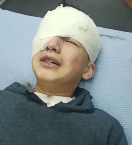 طفل يفقد عينه برصاص الاحتلال في الخليل